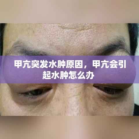 甲亢突发水肿原因,甲亢会引起水肿怎么办